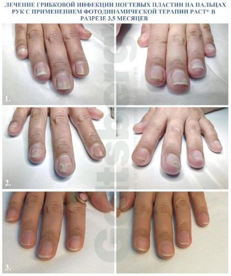 Лечение грибковых поражений ногтей и стоп
