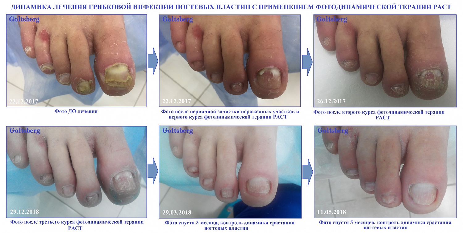 Лечение грибковых поражений ногтей и стоп